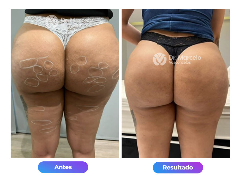 Celulites-Dr-Marcelo-Vasconcelos-1.jpg