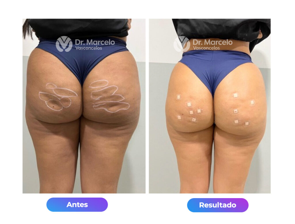 Celulites-Dr-Marcelo-Vasconcelos-2.jpg