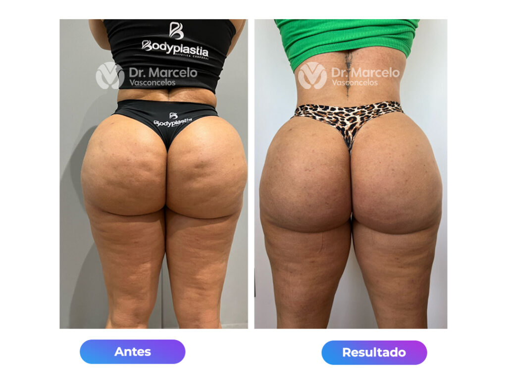 Celulites-Dr-Marcelo-Vasconcelos-3.jpg