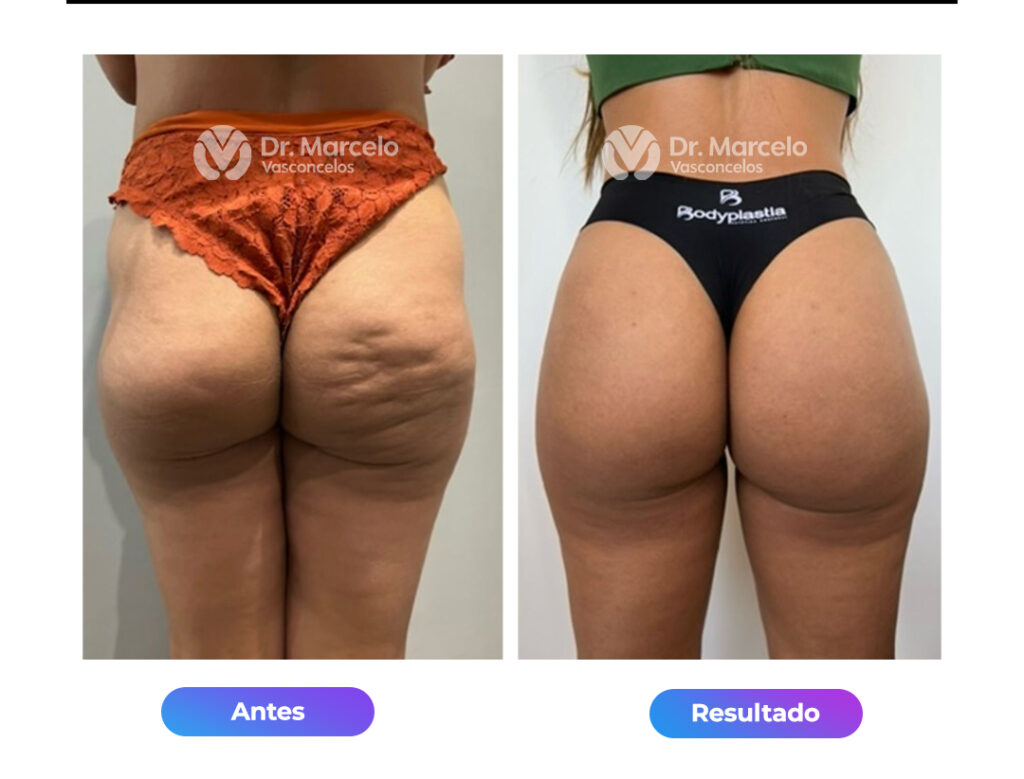Celulites-Dr-Marcelo-Vasconcelos-4.jpg